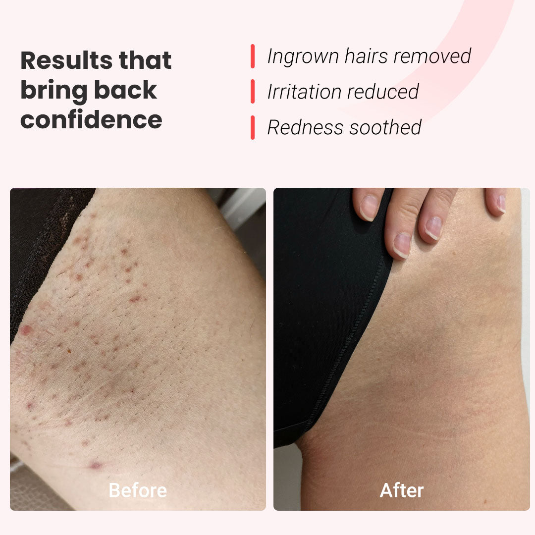 IPL fotoepiliatorius