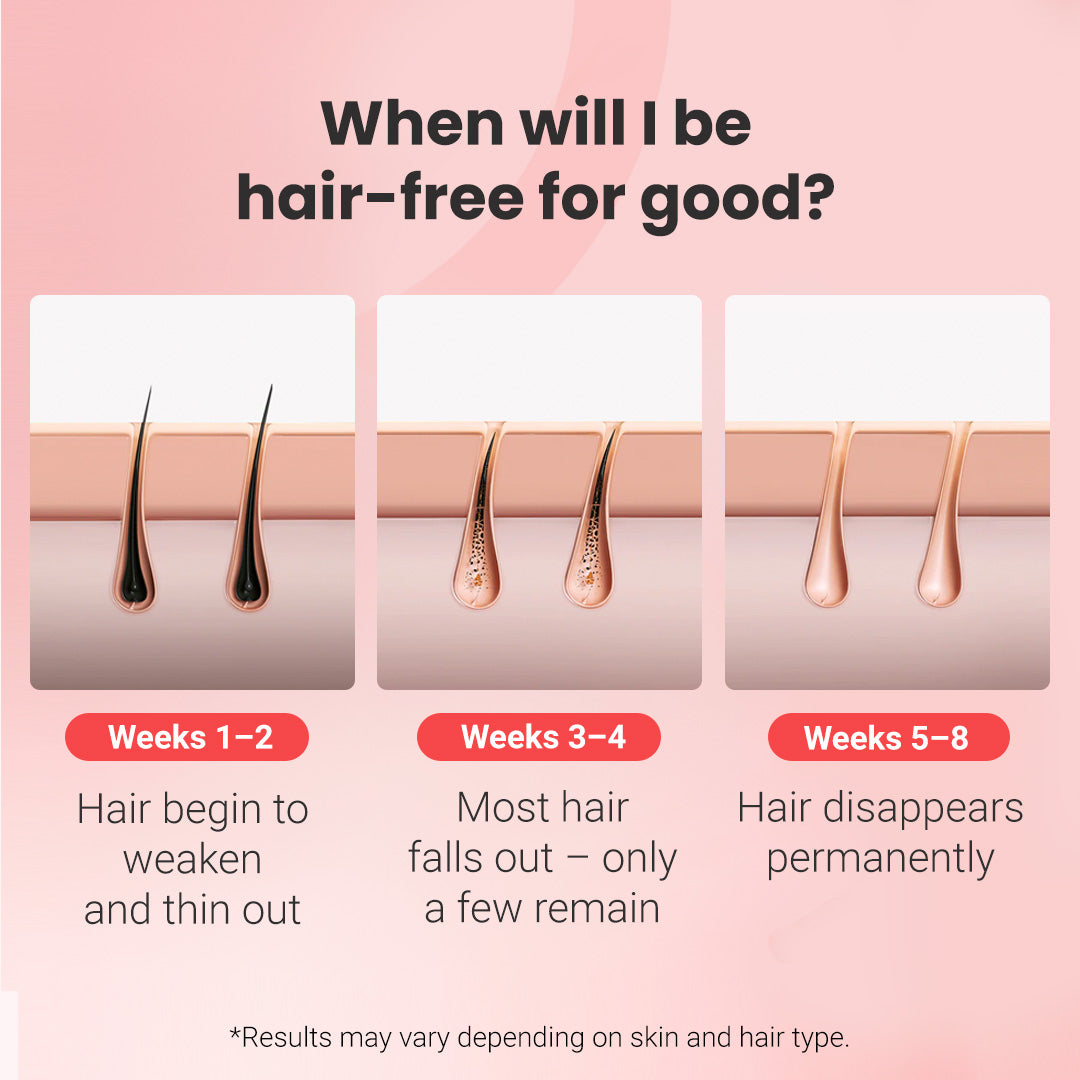 IPL fotoepiliatorius