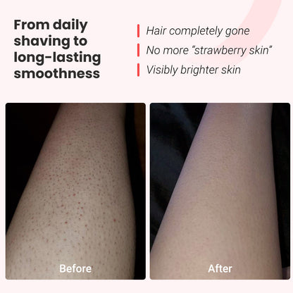 IPL fotoepiliatorius